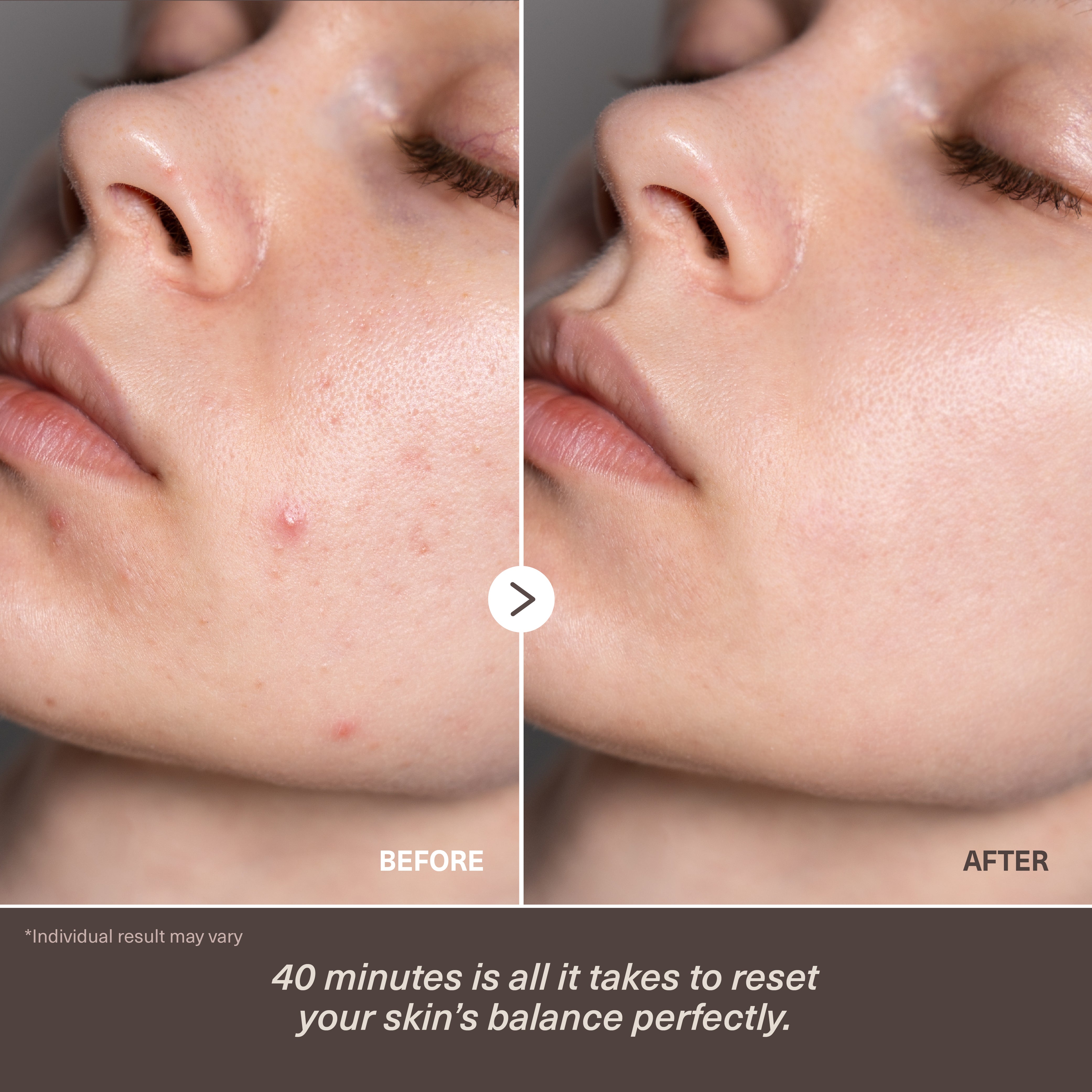 NANO LIPOSOME+ | Advanced Sebum Balance Mask